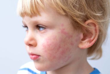 allergie alimentari bambini